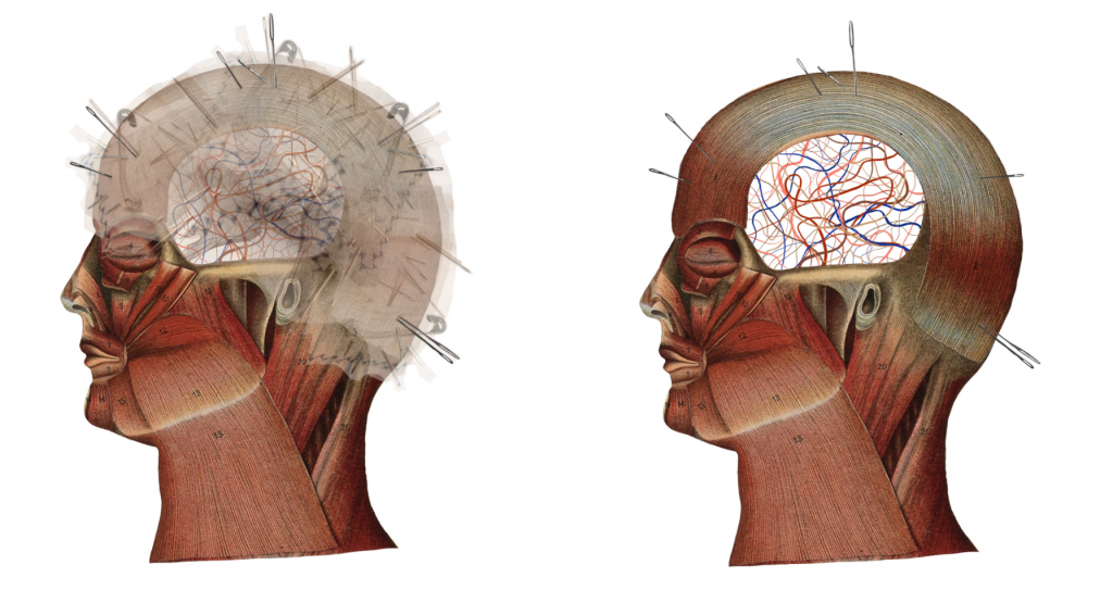 Two digital collages side by side on a white background of illustrations of the cross section of a head showing the layer of muscles. There is a section of the head cut out in the middle and the appearance of line drawn wires inside the gap. There are also pins and needles and stitches in the heads to give the impression of pain. 