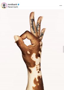 vitiligo right hand.The hand is in the centre of the frame in the ok gesture/signal. three of the fingers are tattooed with Love, Kindness and Compassion